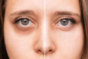 Woman with under eye circles
